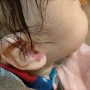 AHSスターバンドヘルメット治療の体験談｜トップページ