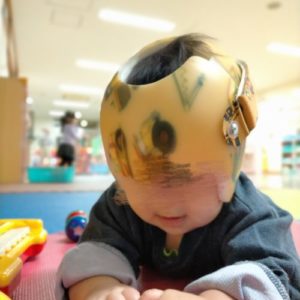 AHSスターバンドヘルメット治療57日目:検診で‥頭が縮んでる??
