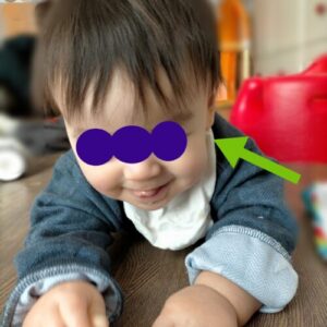 AHSスターバンドヘルメット治療の体験談｜トップページ